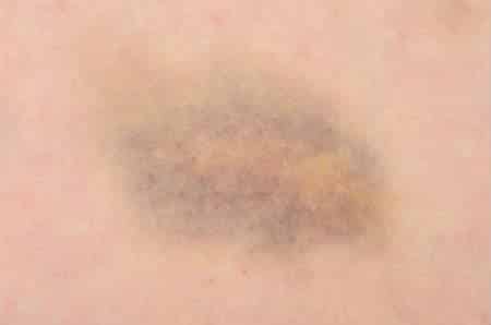 Bruise on Elderly person
