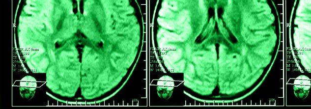 CT Brain Scan