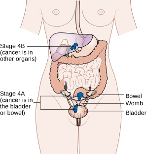 Advanced stages of uterine cancer can spread far beyond the pelvic region.