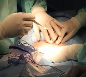 Essure Implantation