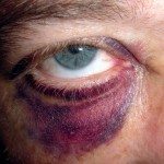 Eye injuries after bar fight