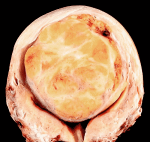 Image of a large uterine fibroid, taken by Ed Uthman, MD.