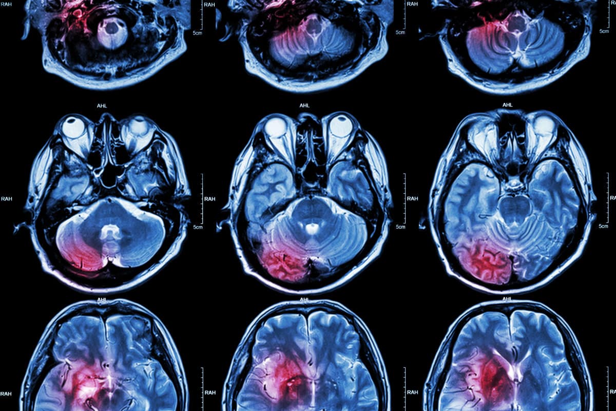 MRI of brain tumors