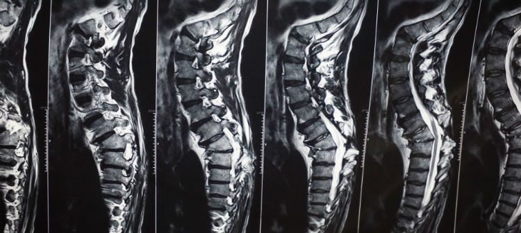 Spinal X-Rays