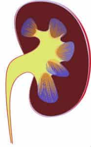 a kidney with stones