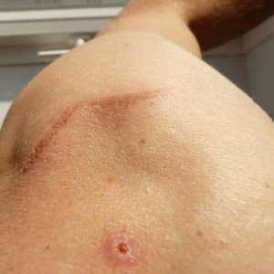 shoulder scar