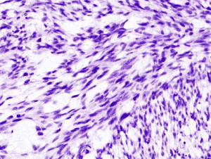 Microscopic image of uterine leiomyosarcoma