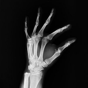x-ray of fractured bone