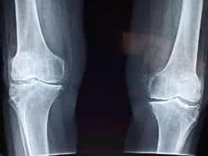 x-ray of the knees