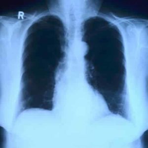 x-ray of the lungs