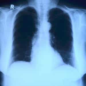 x-ray-of-the-ribs-and-chest-in-medical-malpractice-case